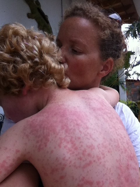 The rash. Yikes.